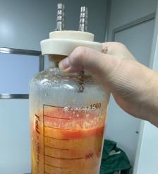 吕梁水动力吸脂手术要做多久？